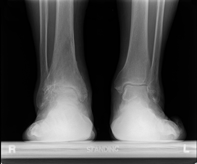 Radiograph prior to treatment